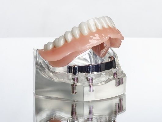 Model of All on 4 implant denture in lower jaw
