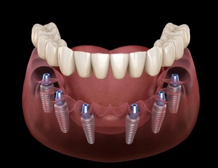 Illustrated denture being placed onto six dental implants