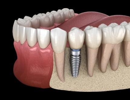 Illustrated dental implant in the lower jaw