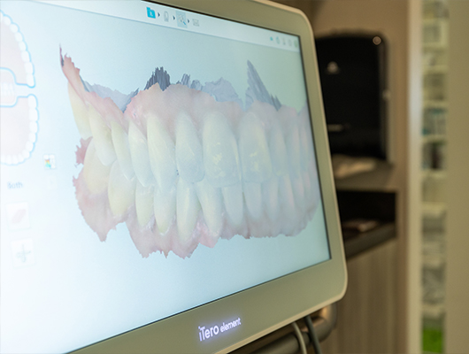 Computer screen showing digital impressions of teeth