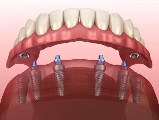 Illustrated denture being placed onto six dental implants throughout the jaw