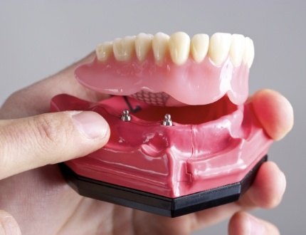 Dentist holding model of removable lower implant denture
