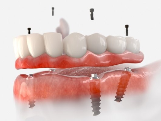 Illustrated denture being fitted onto four dental implants