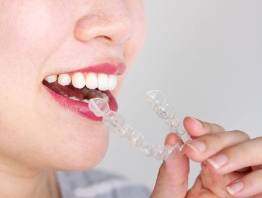 Close up of woman placing Invisalign aligner in her mouth