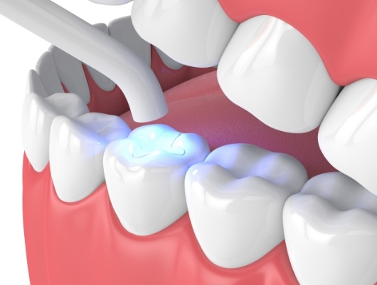 Illustrated dental light hardening a tooth colored filling