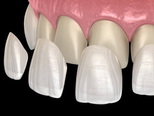 Several illustrated veneers being placed over front teeth