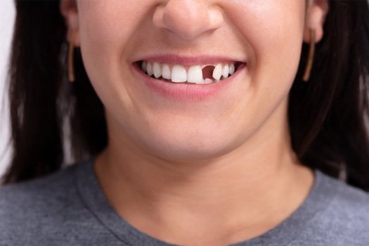 Patient in Shady Shores showing missing tooth