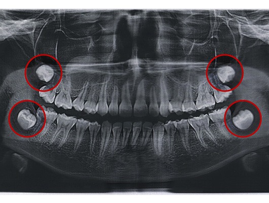 X-ray that highlights the wisdom teeth