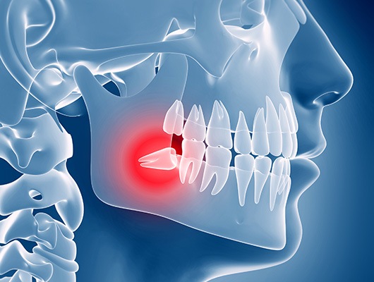 Digital model showing wisdom teeth coming in crooked