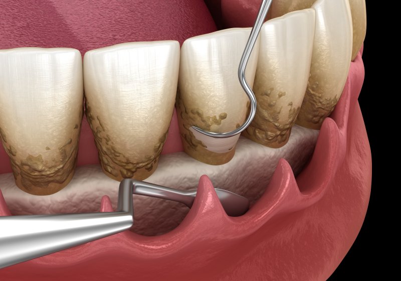 digital image of scaling and root planing